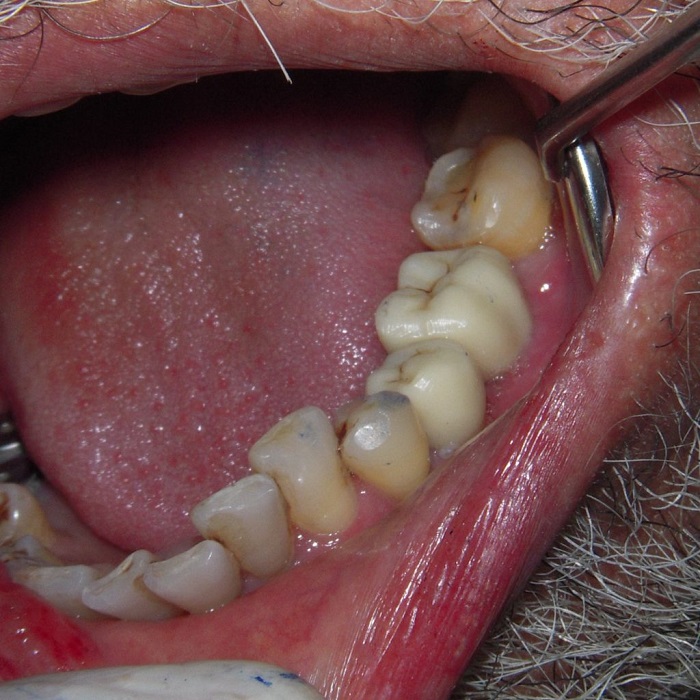 Multiple Teeth Implants After