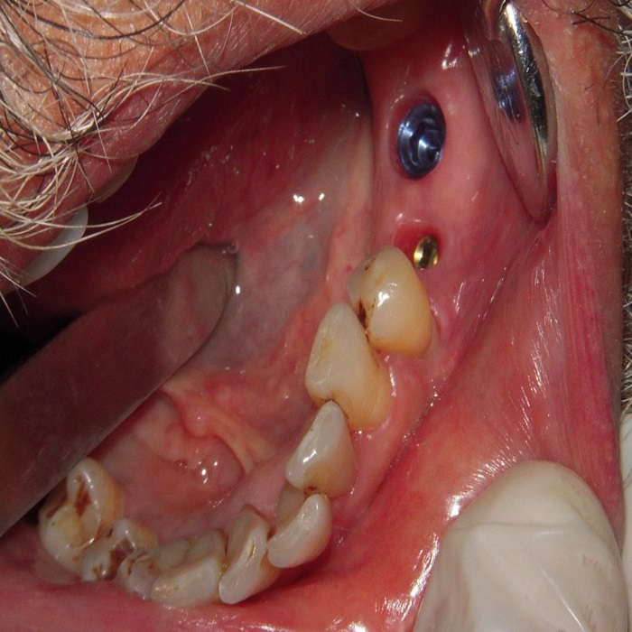 Multiple Teeth Implants Before