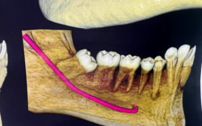 How to Find the Best Dentist for Wisdom Teeth Surgery in South Extension Part 1?