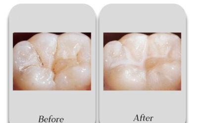 Why Are Pit & Fissure Sealants Important for Children in South Extension 1?