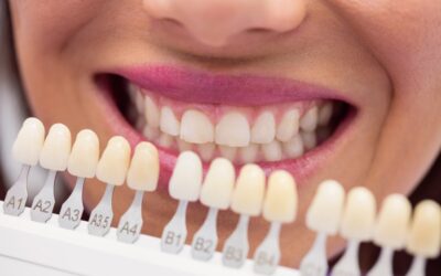 How to Find the Best Teeth Laminate Treatment in South Extension 1 for a Perfect Smile?