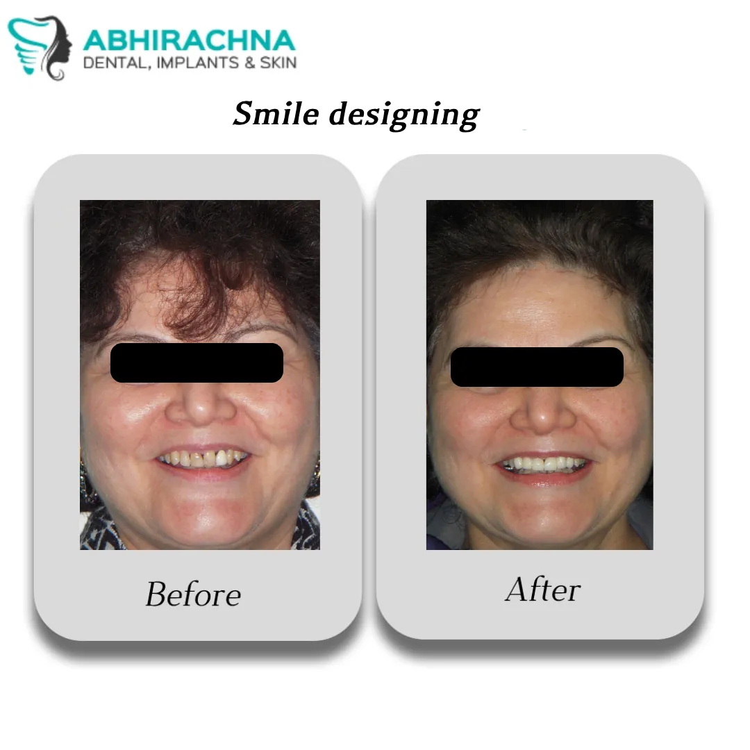 Smile Designing treatment at Abhirachna Dental, South Extension