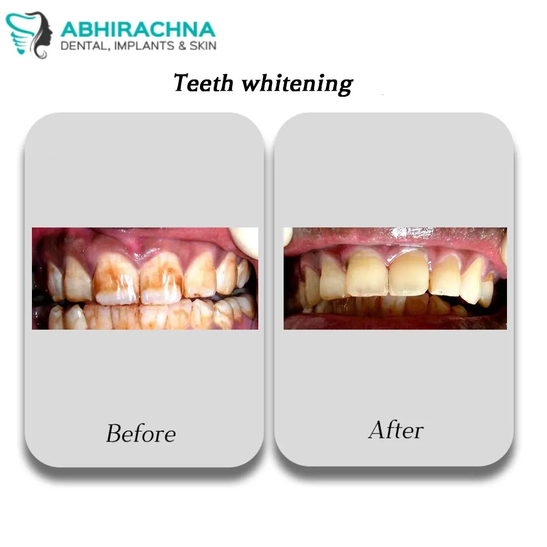 Tooth Whitening treatment at Abhirachna Dental, South Extension