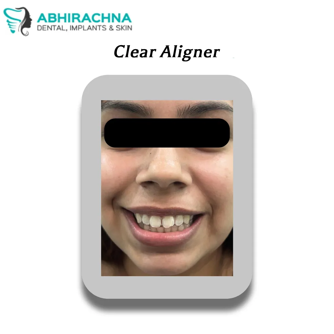 Clear Aligners / Invisalign treatment at Abhirachna Dental, South Extension
