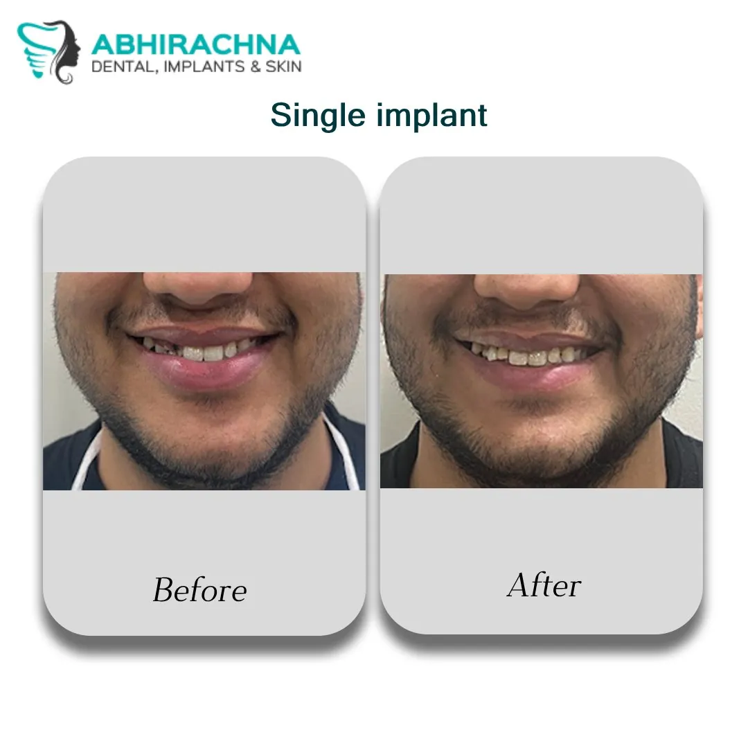 Single Tooth Implant treatment at Abhirachna Dental, South Extension