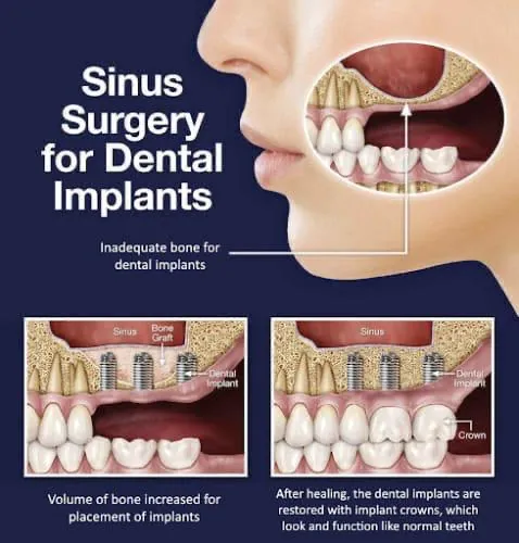 Sinus Lift treatment at Abhirachna Dental, South Extension