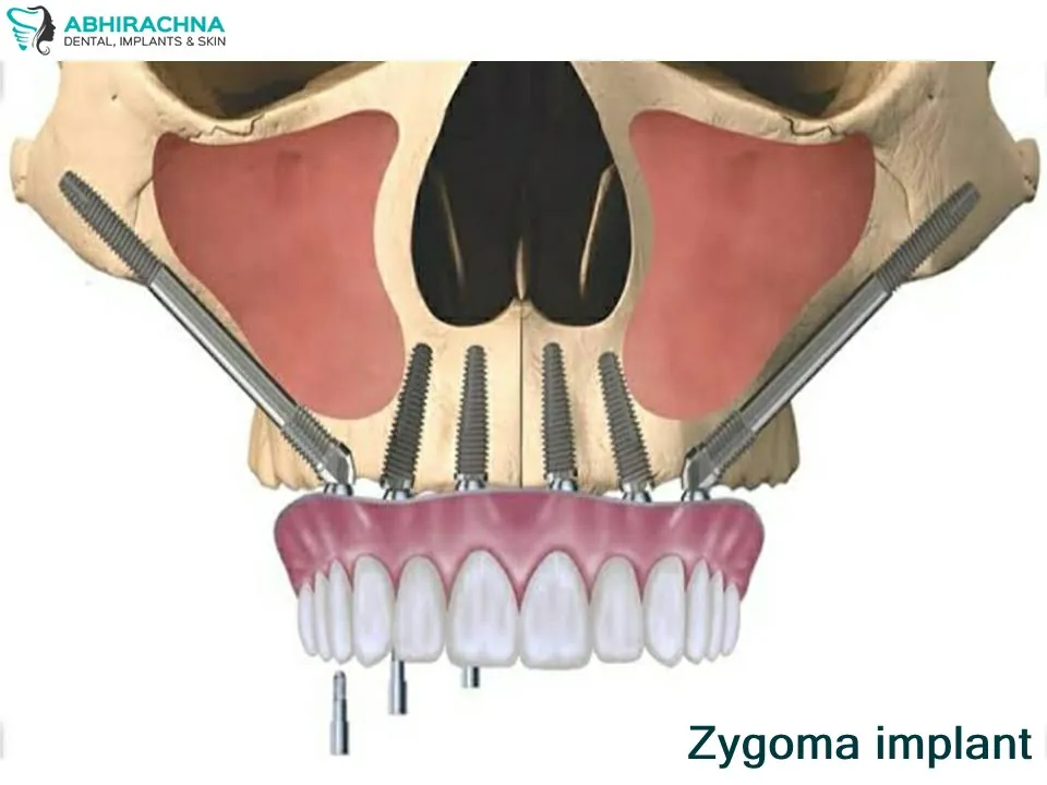 Zygoma Implant treatment at Abhirachna Dental, South Extension