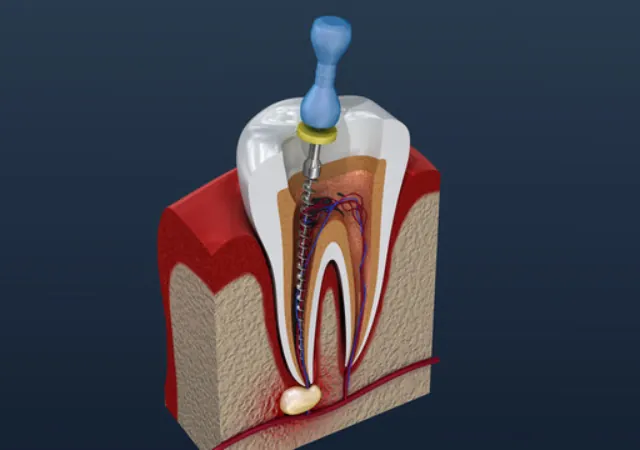Root Canal Treatment at Abhirachna Dental, South Extension