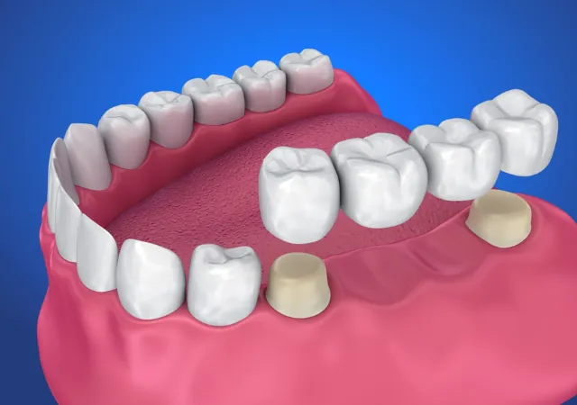 Crowns & Bridges treatment at Abhirachna Dental, South Extension
