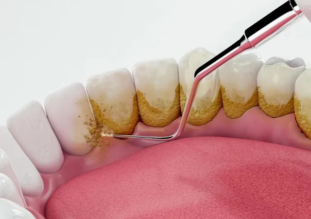 Scaling & Polishing treatment at Abhirachna Dental, South Extension