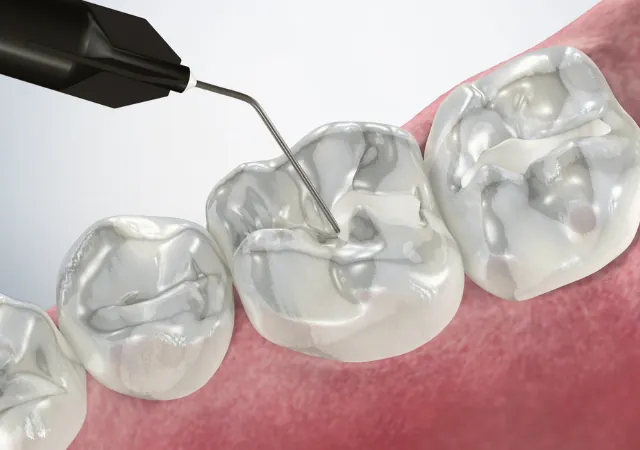 Pit & Fissure Sealants treatment at Abhirachna Dental, South Extension