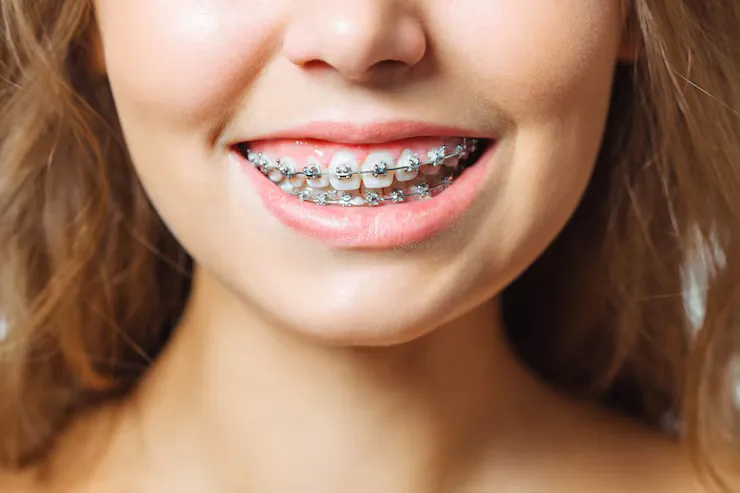 Metal Braces treatment at Abhirachna Dental, South Extension