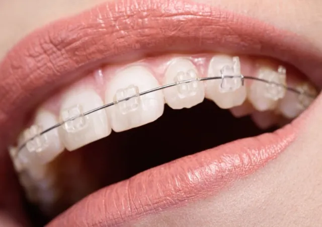 Ceramic Braces treatment at Abhirachna Dental, South Extension
