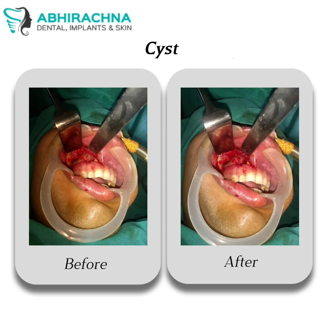 Cyst treatment at Abhirachna Dental, South Extension