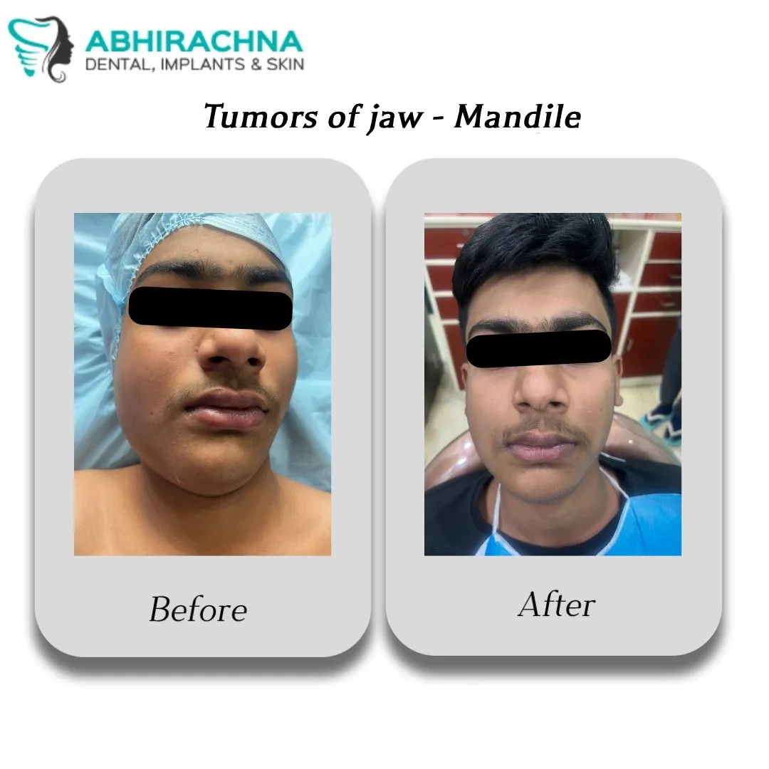 Tumours treatment at Abhirachna Dental, South Extension