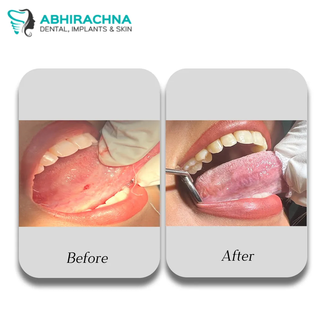 Biopsy treatment at Abhirachna Dental, South Extension
