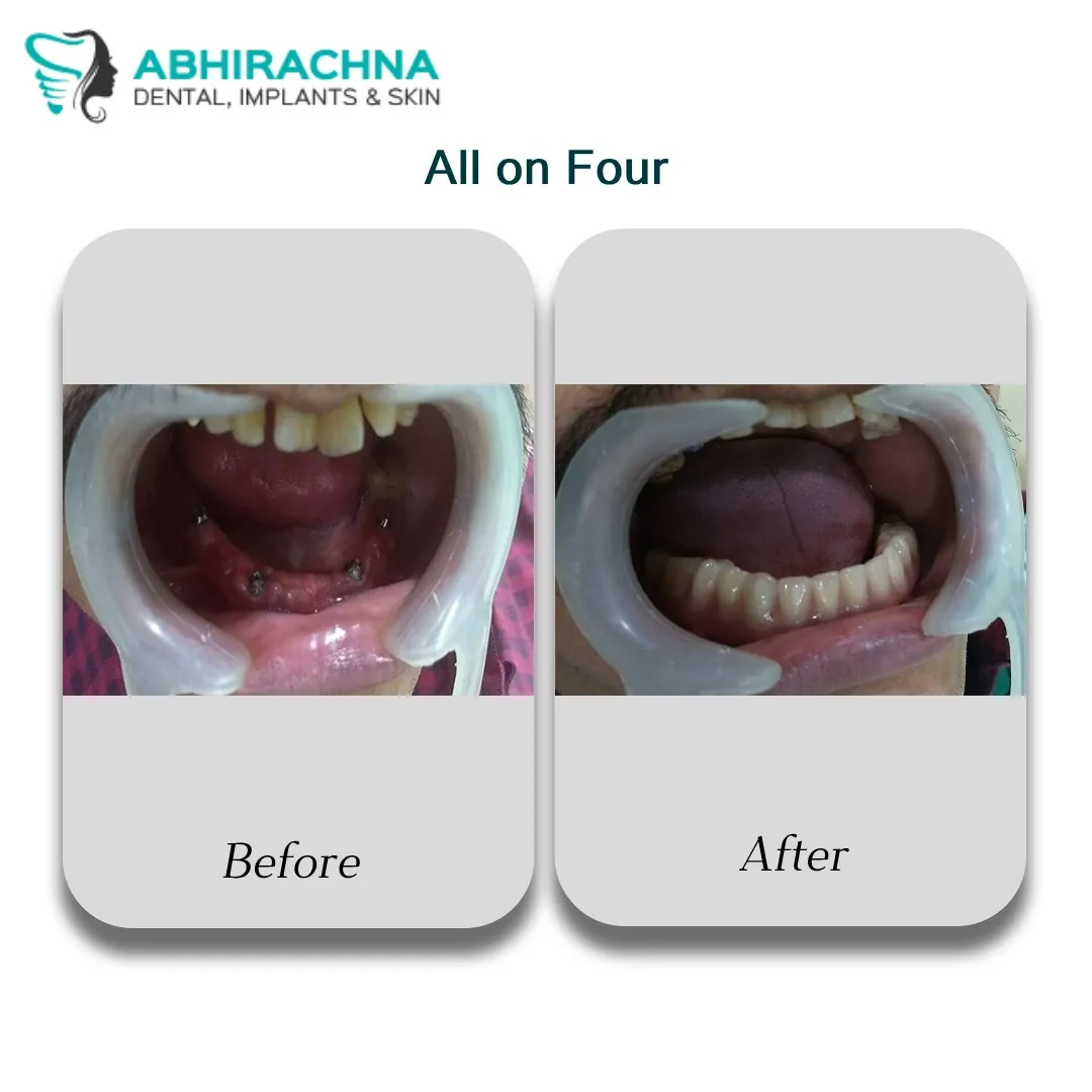 All On Four/Full before and after result at Abhirachna Dental, South Extension - image 1