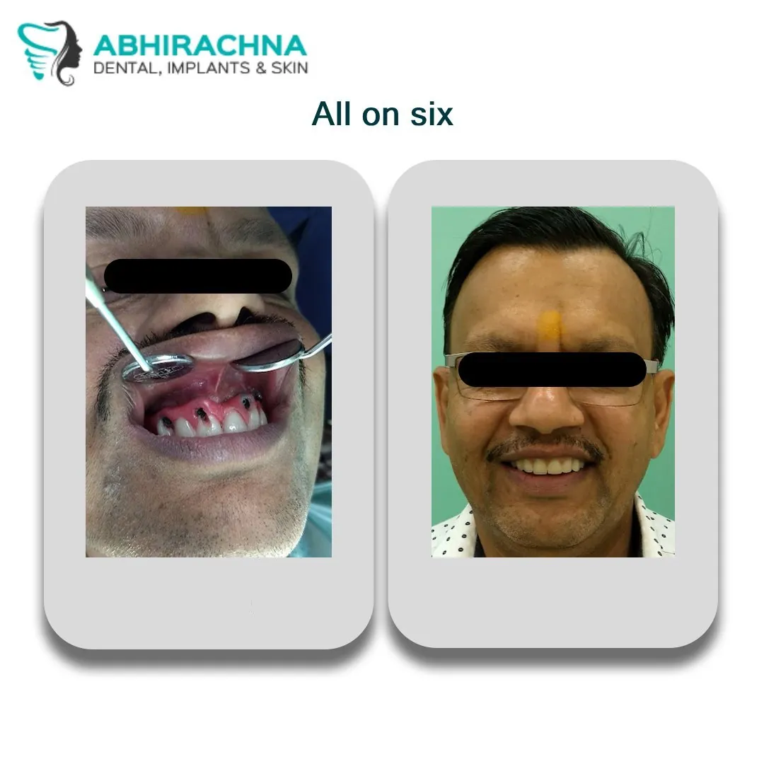 All On Four/Full before and after result at Abhirachna Dental, South Extension - image 2