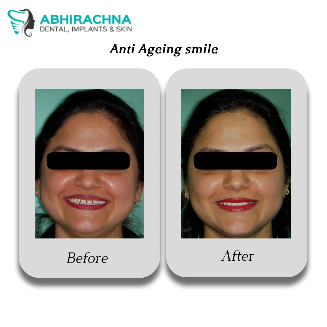 Smile Makeover & Designing before and after result at Abhirachna Dental, South Extension - image 7