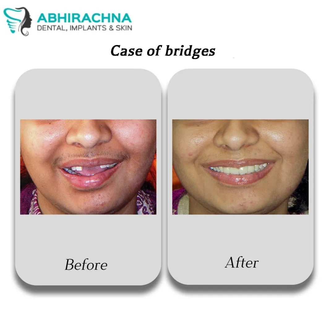 Crowns & Bridges before and after result at Abhirachna Dental, South Extension - image 2