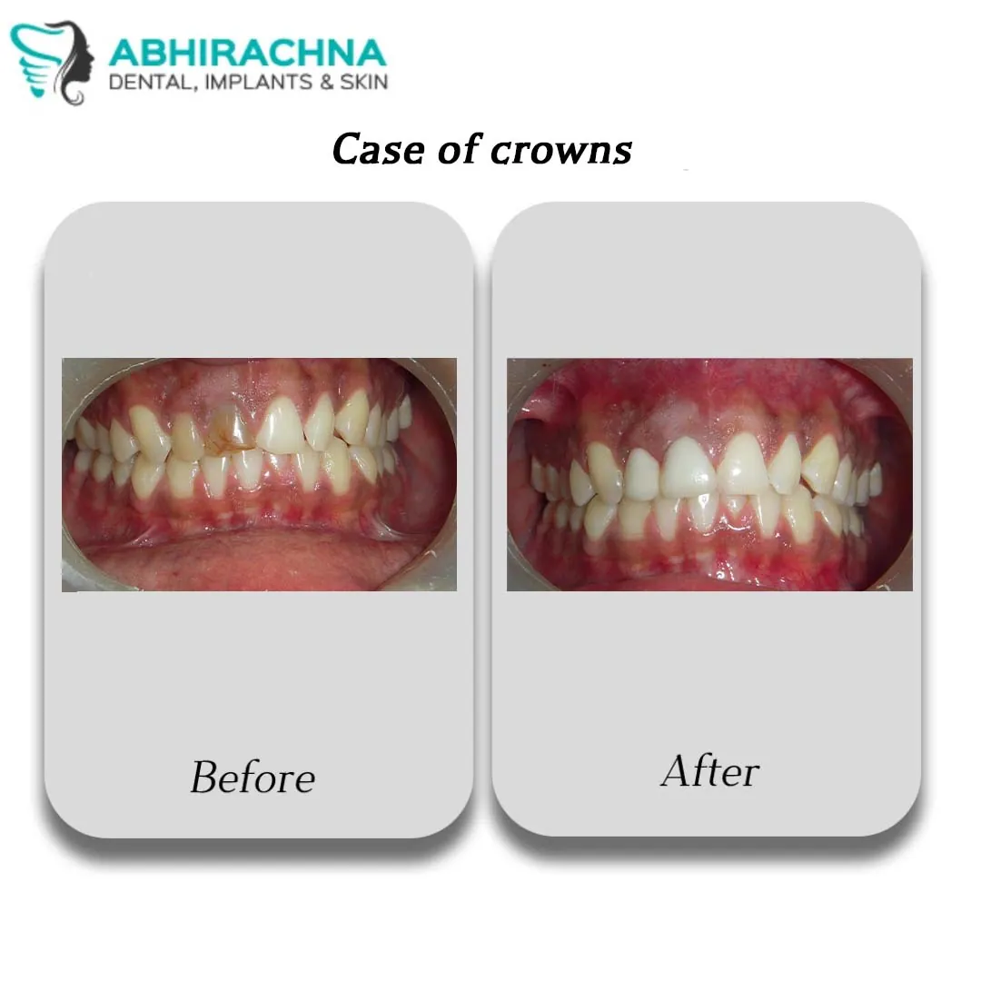 Crowns & Bridges before and after result at Abhirachna Dental, South Extension - image 1