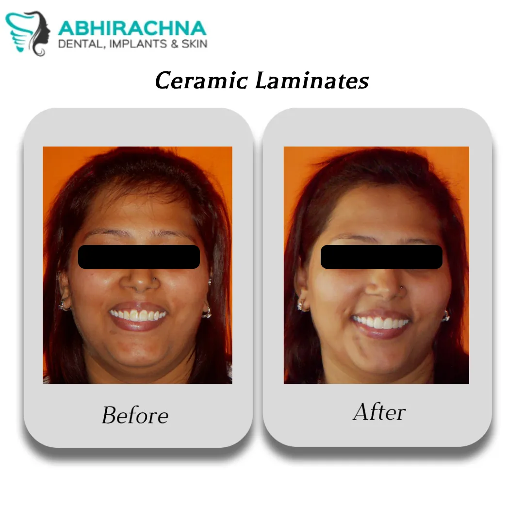 Ceramic Veneers before and after result at Abhirachna Dental, South Extension