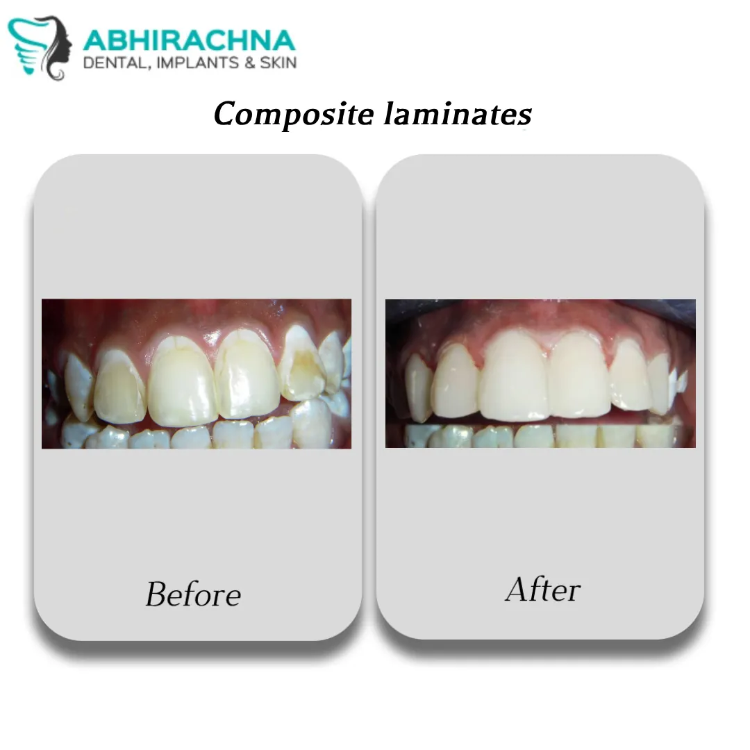 Composite Laminates before and after result at Abhirachna Dental, South Extension