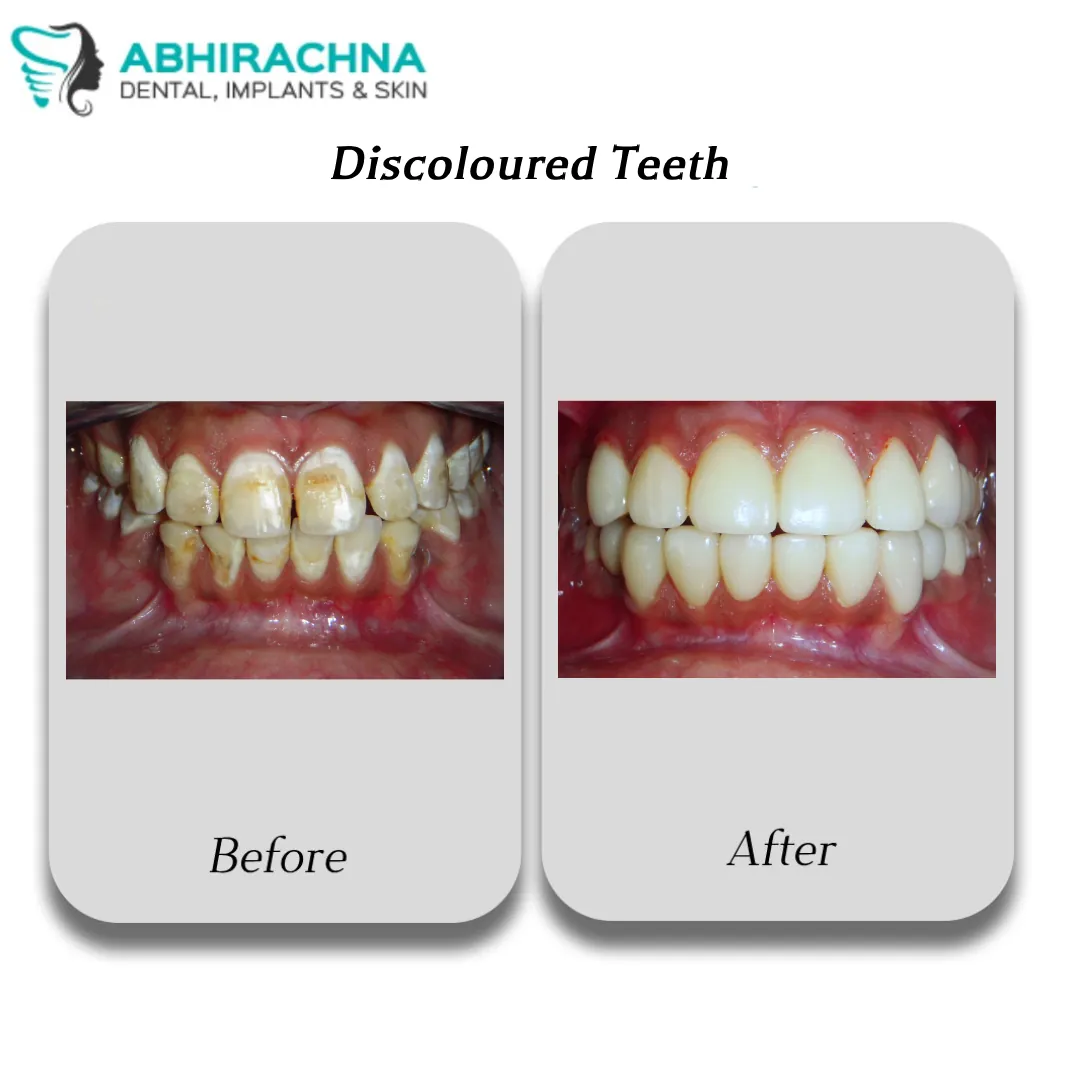 Smile Makeover & Designing before and after result at Abhirachna Dental, South Extension - image 6