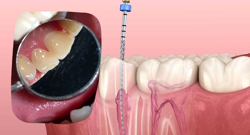 Best Root Canal Treatment in South Extension