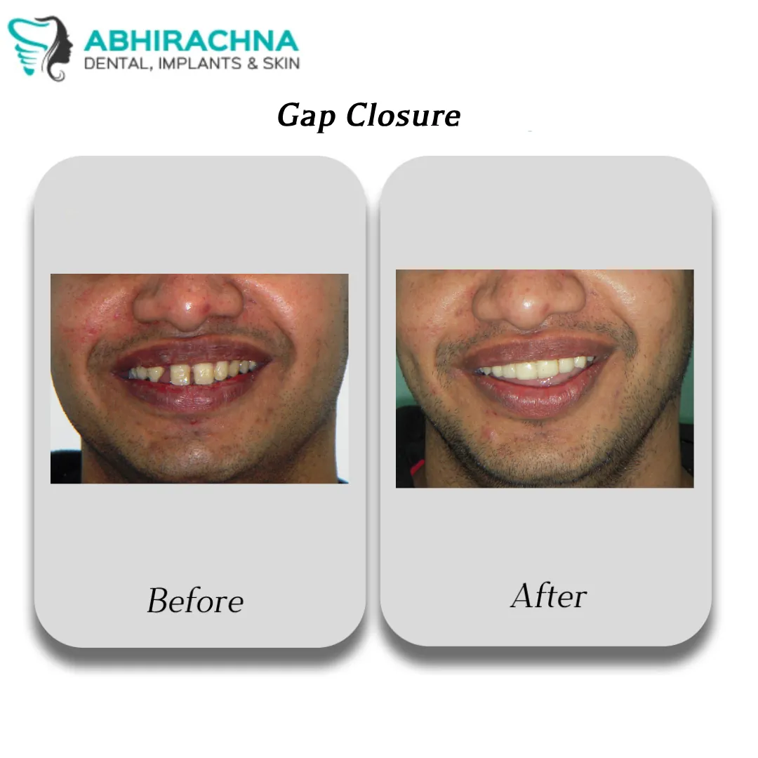 Smile Makeover & Designing before and after result at Abhirachna Dental, South Extension - image 5