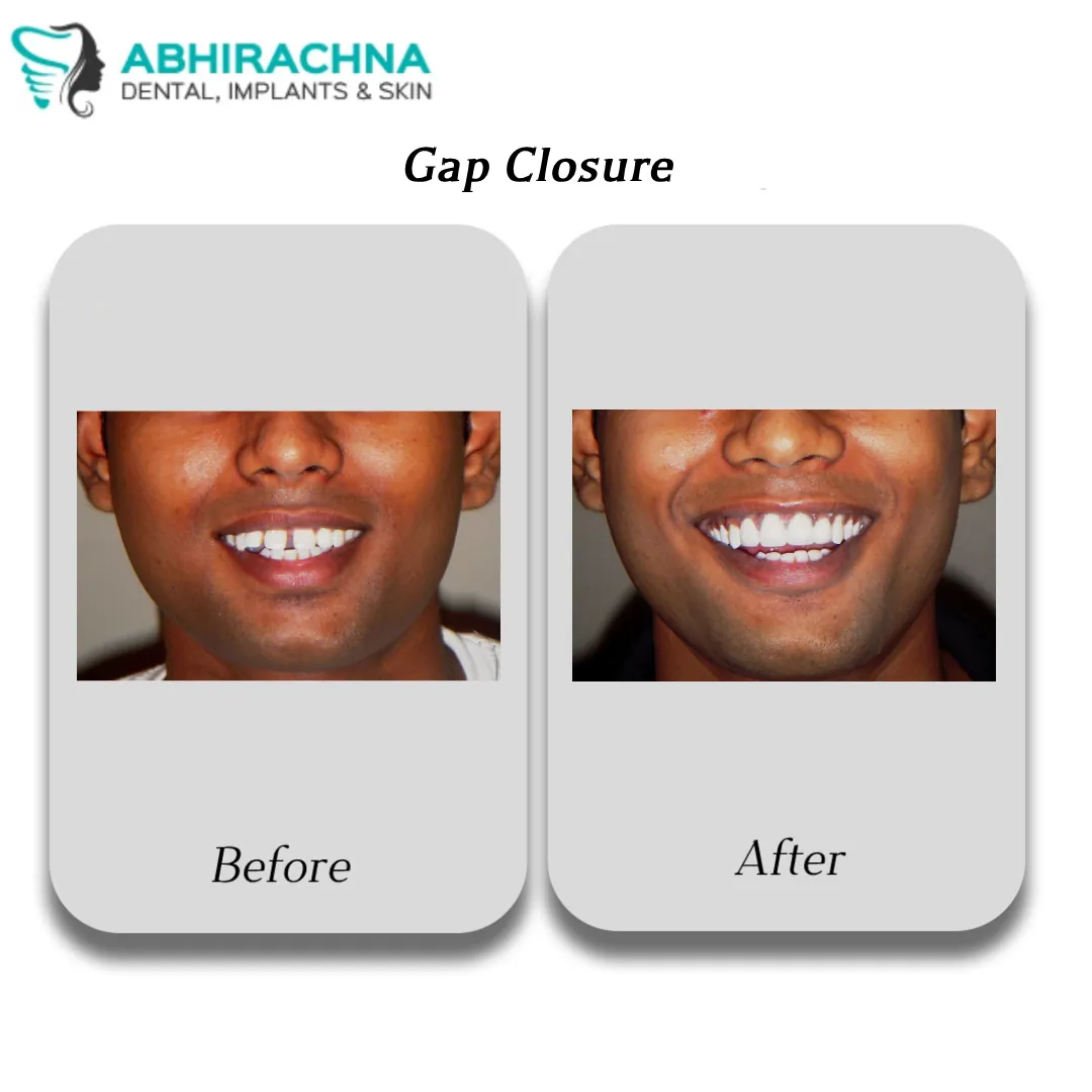 Smile Makeover & Designing before and after result at Abhirachna Dental, South Extension - image 4