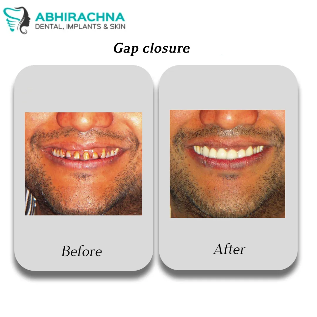 Smile Makeover & Designing before and after result at Abhirachna Dental, South Extension - image 3