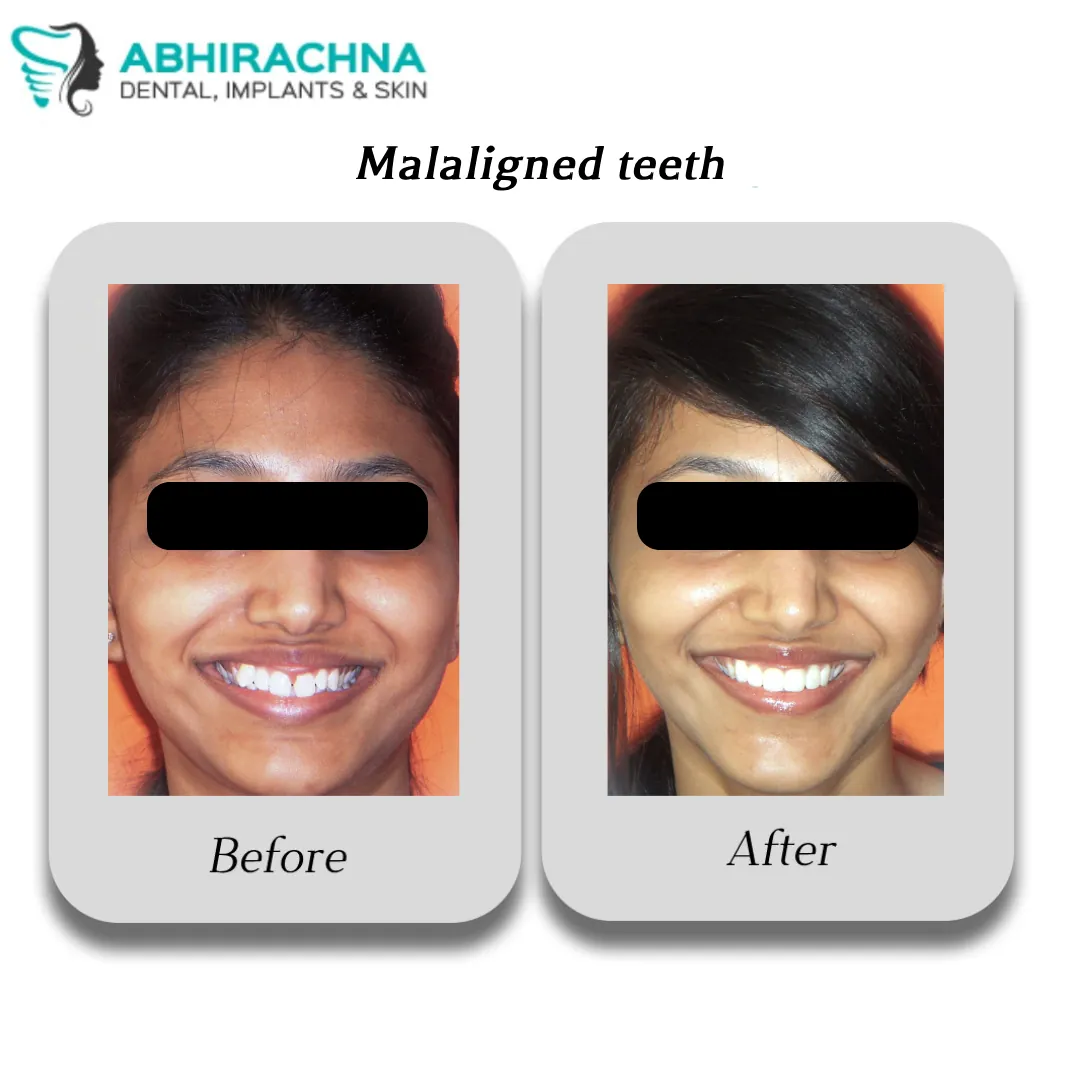 Smile Makeover & Designing before and after result at Abhirachna Dental, South Extension - image 2