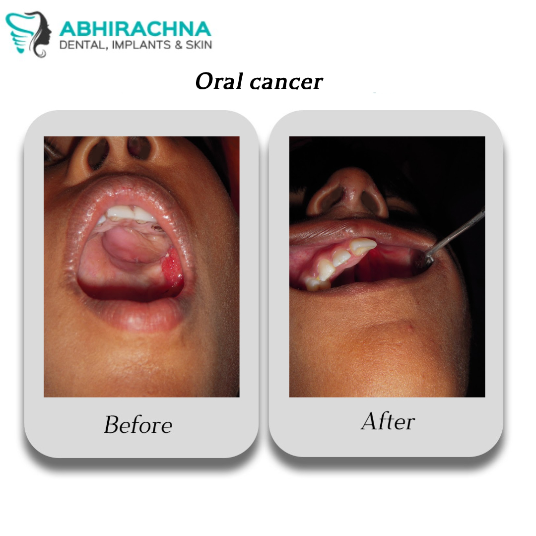 Oral Cancer Oral Cancer