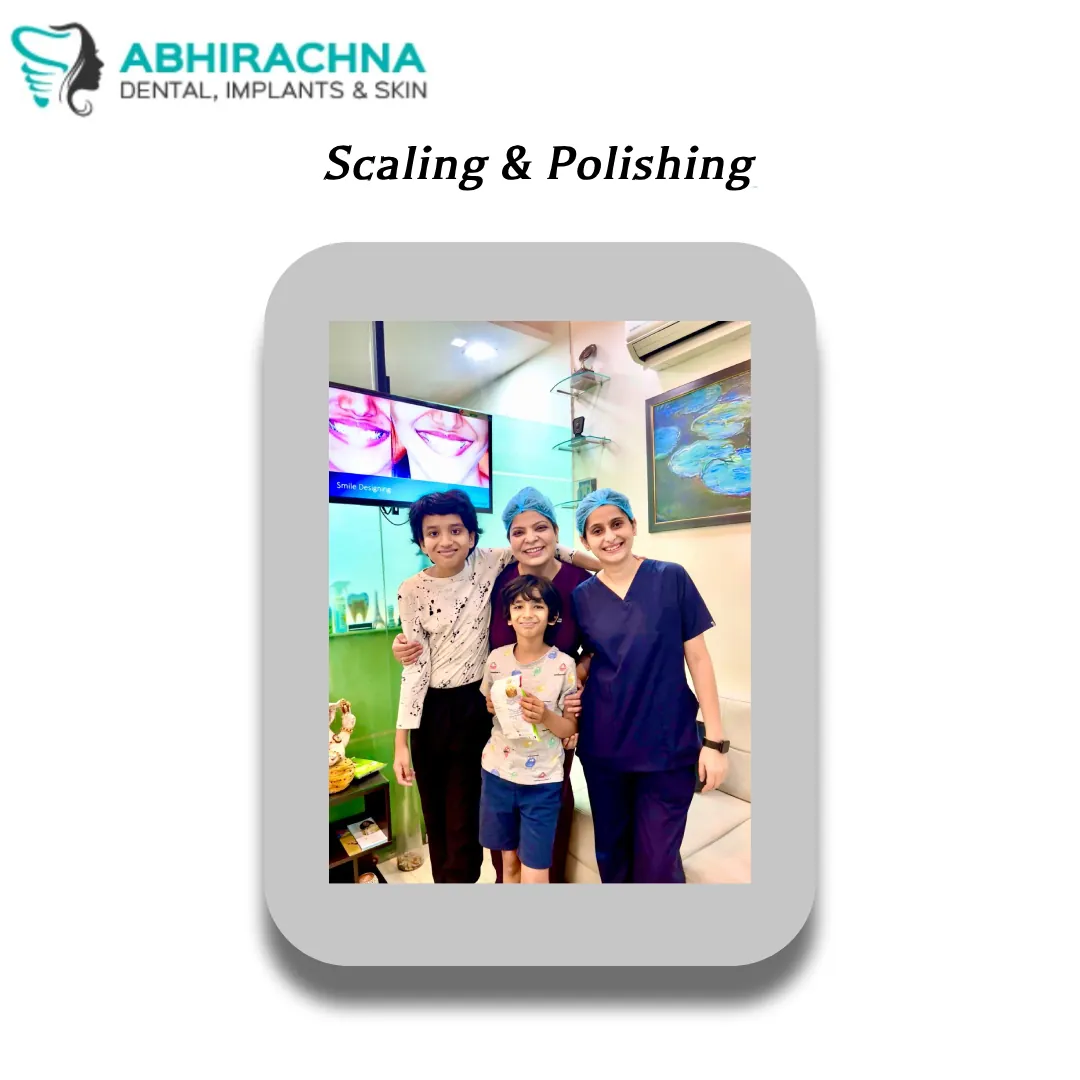 Scaling & Polishing before and after result at Abhirachna Dental, South Extension - image 2