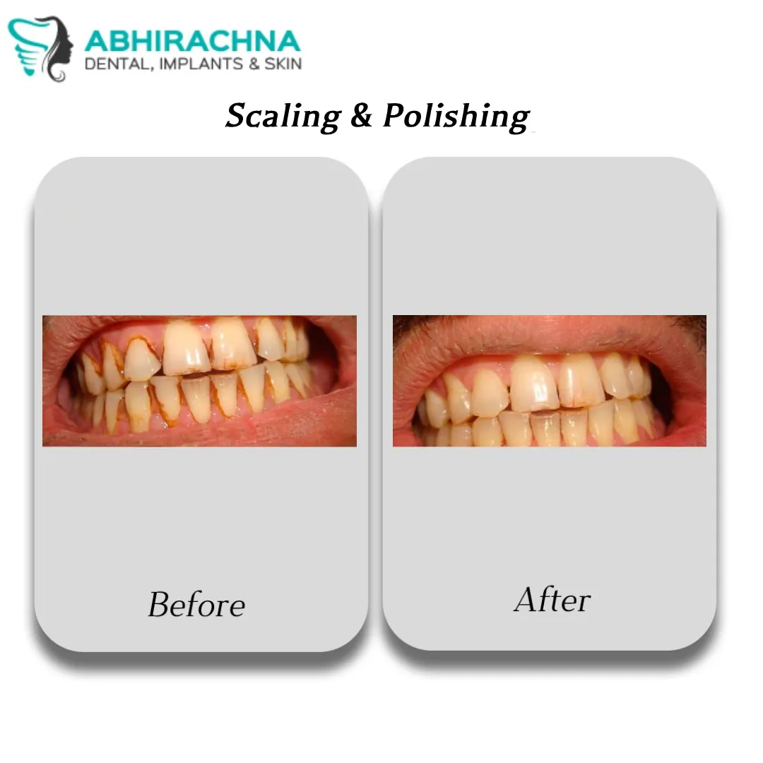 Scaling & Polishing before and after result at Abhirachna Dental, South Extension - image 1