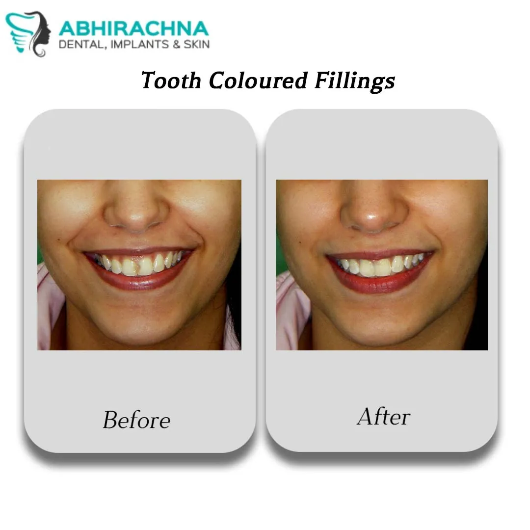 Tooth Coloured Fillings before and after result at Abhirachna Dental, South Extension - image 1