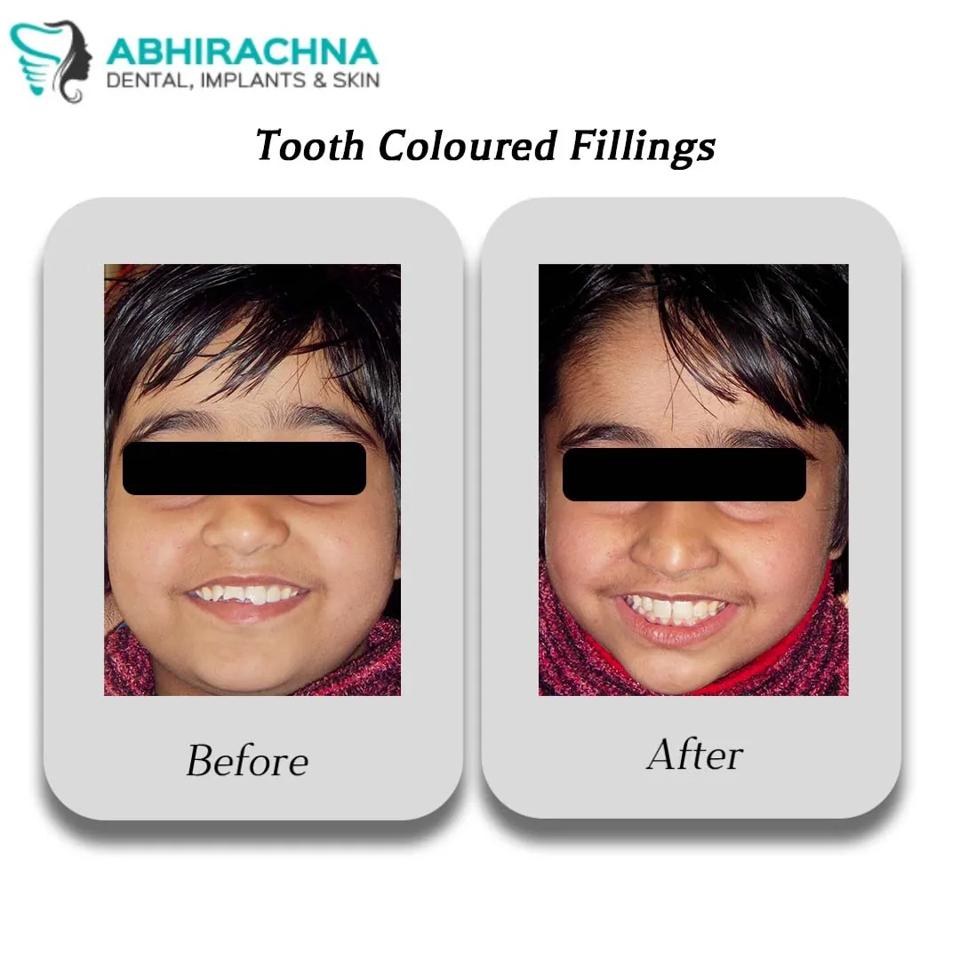 Tooth Coloured Fillings before and after result at Abhirachna Dental, South Extension - image 2