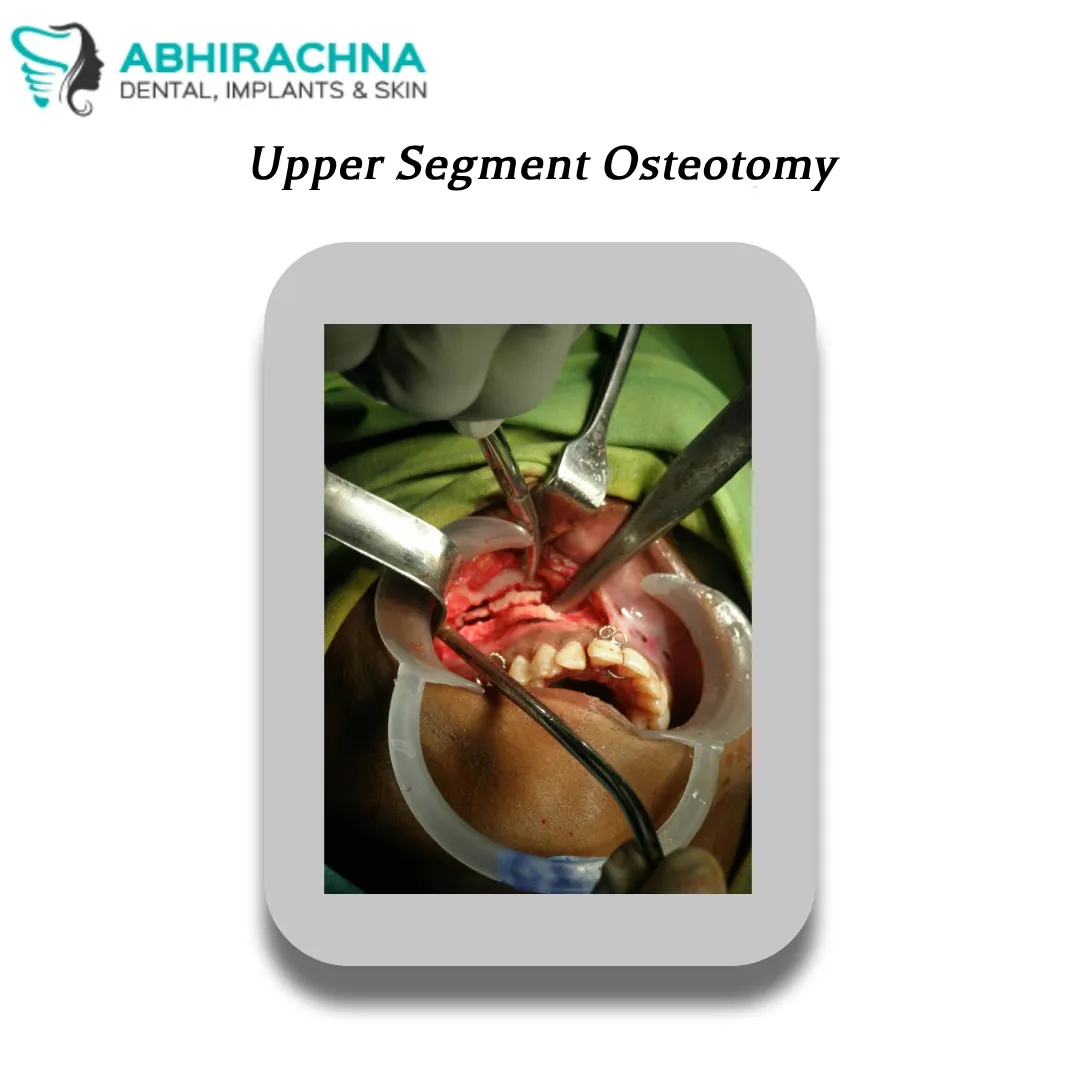 Upper Segment Osteotomy before and after result at Abhirachna Dental, South Extension