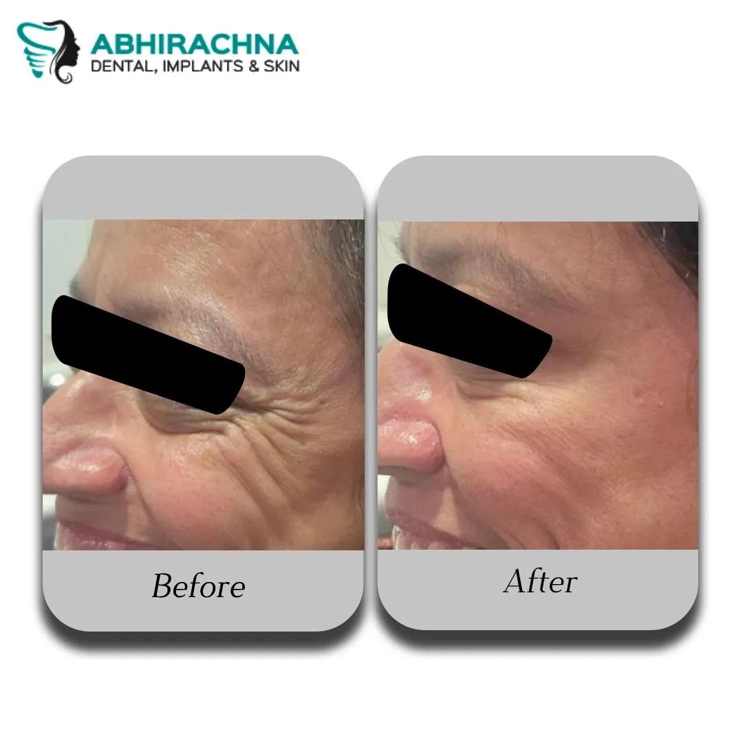 Anti Aging before and after result at Abhirachna Dental, South Extension