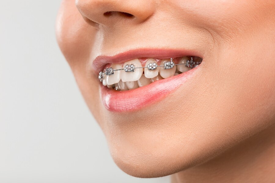 Top-Quality Metal Braces in South Extension at Abhirachna Dental