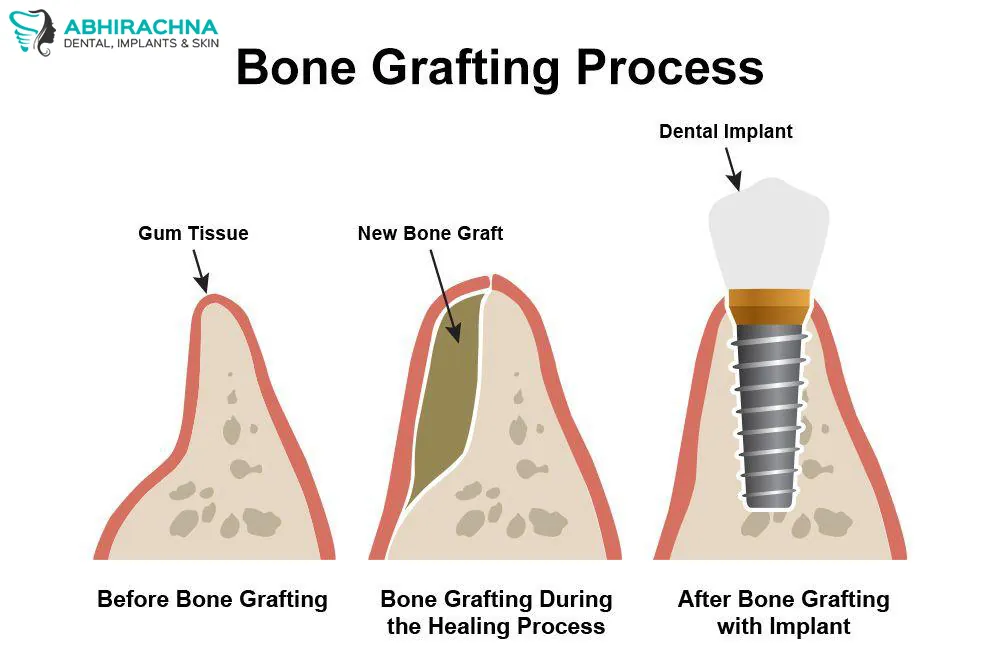Bone Grafting before and after result at Abhirachna Dental, South Extension - image 1