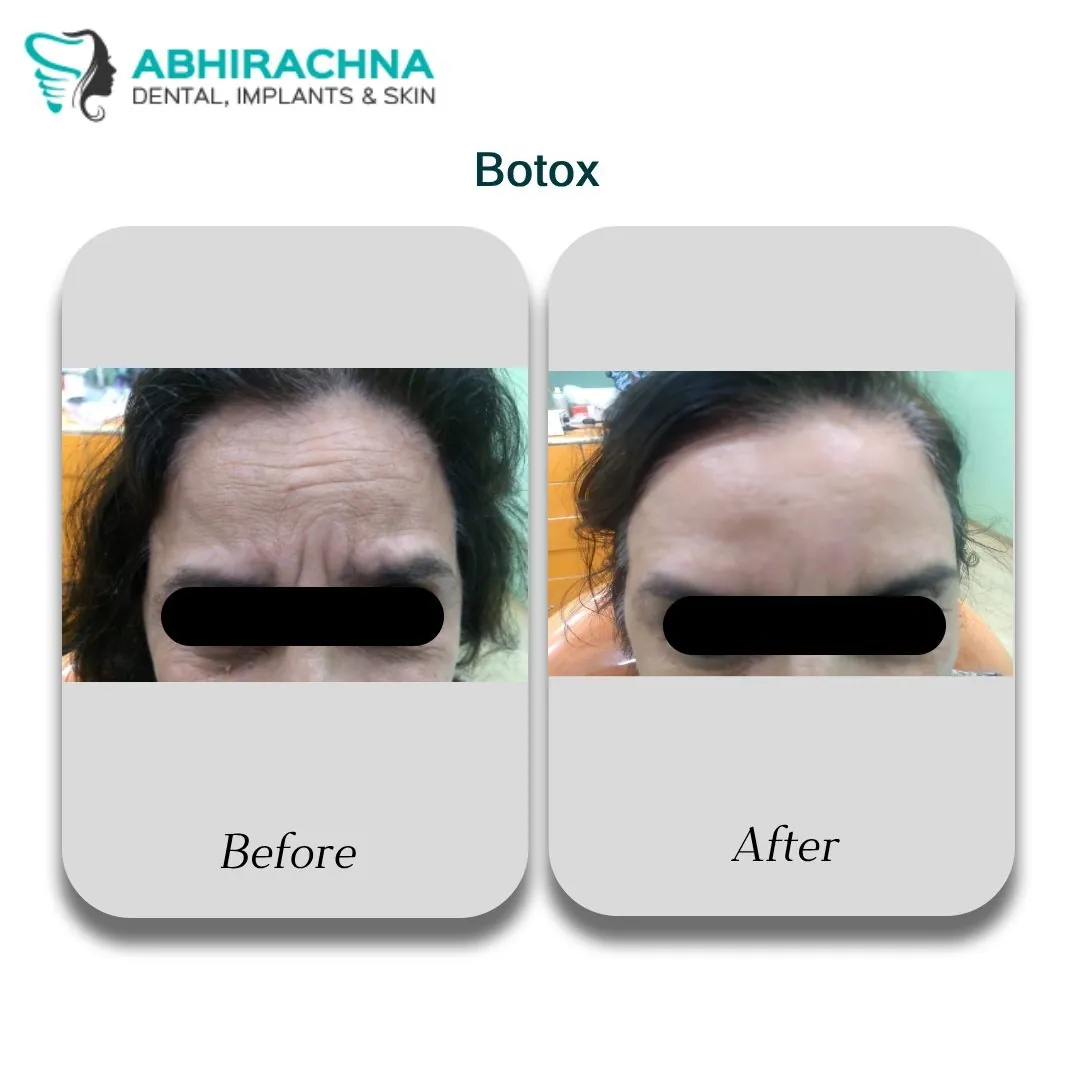 Botox before and after result at Abhirachna Dental, South Extension - image 1
