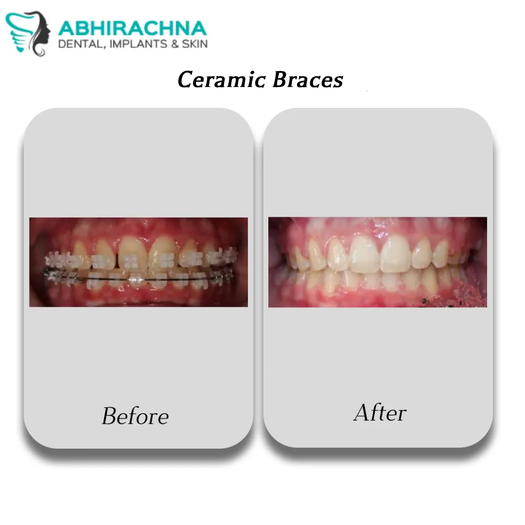 Ceramic Braces before and after result at Abhirachna Dental, South Extension