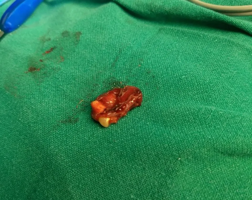 Cyst before and after result at Abhirachna Dental, South Extension - image 2