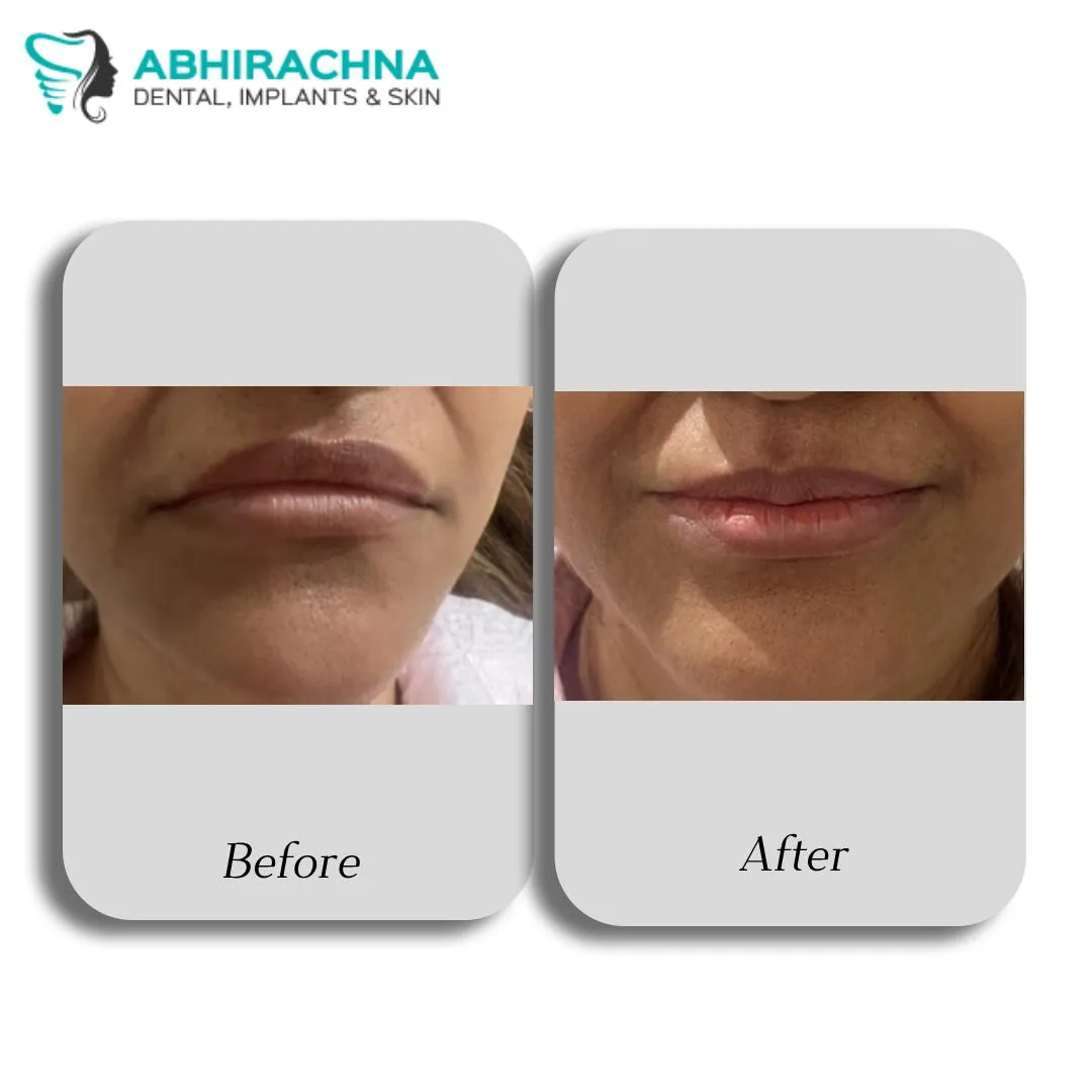 Fillers before and after result at Abhirachna Dental, South Extension - image 1
