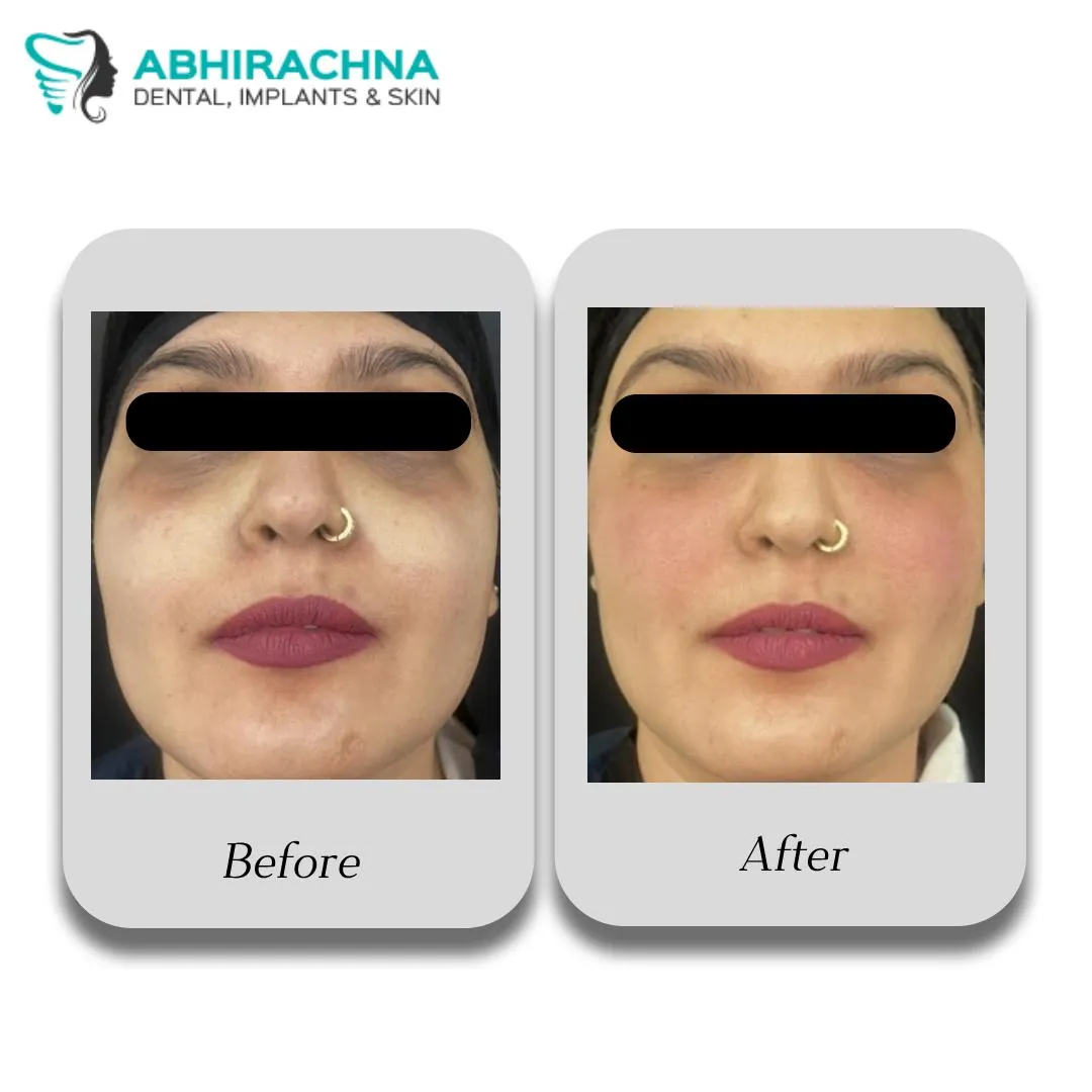Fillers before and after result at Abhirachna Dental, South Extension - image 2