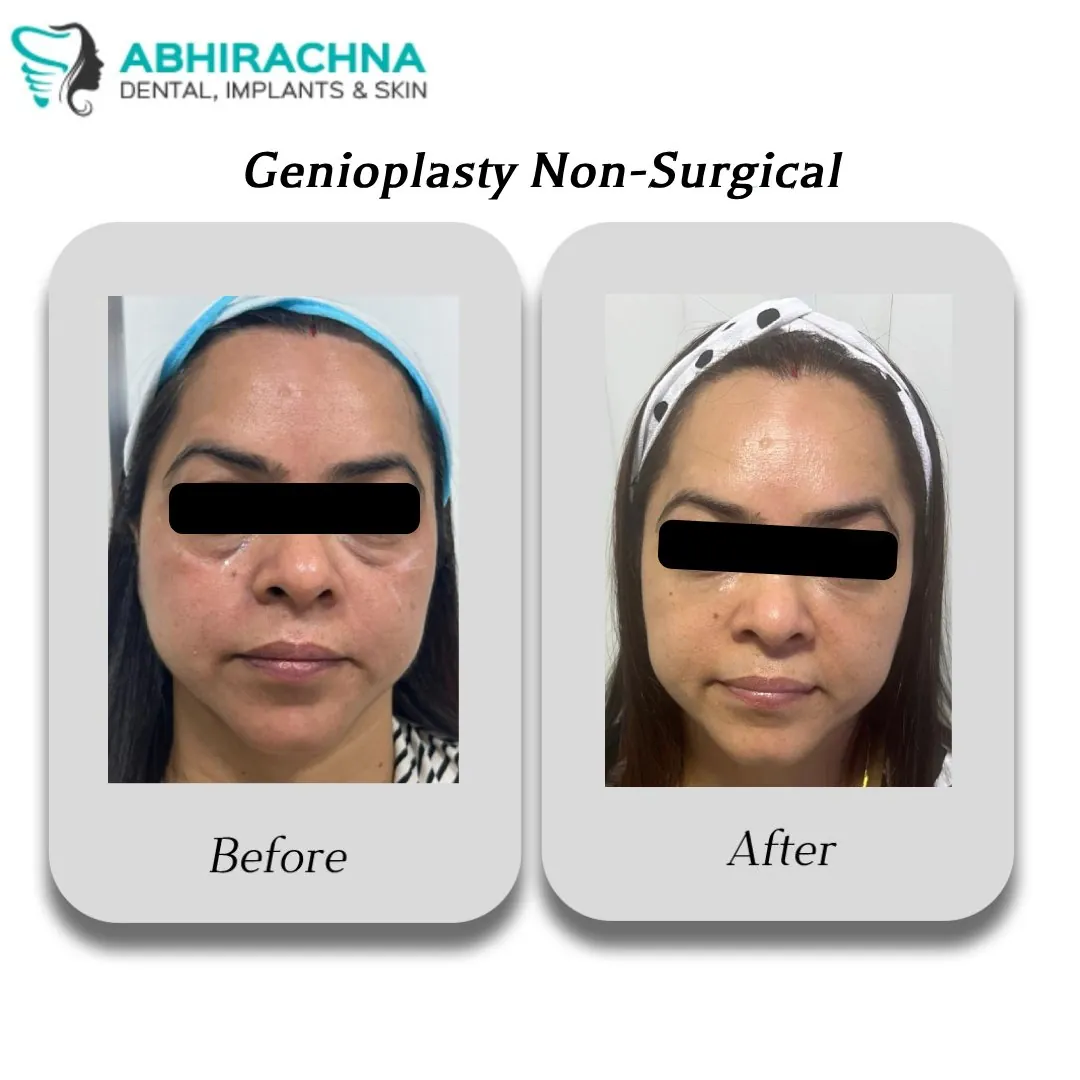 Genioplasty Non-Surgical before and after result at Abhirachna Dental, South Extension - image 2
