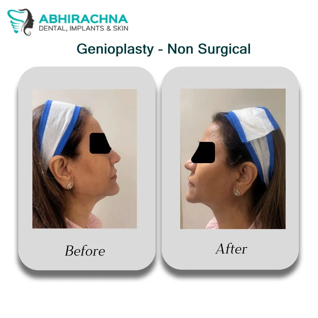 Genioplasty Non-Surgical before and after result at Abhirachna Dental, South Extension - image 1