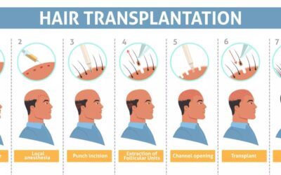 How to Find the Best Hair Transplant Clinic in South Extension?